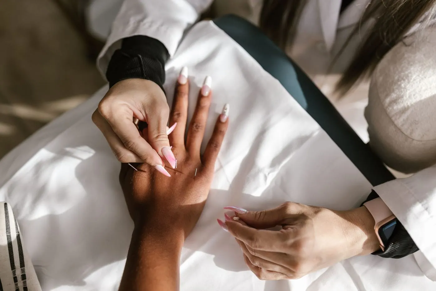 Fine acupuncture needles being placed in a hand