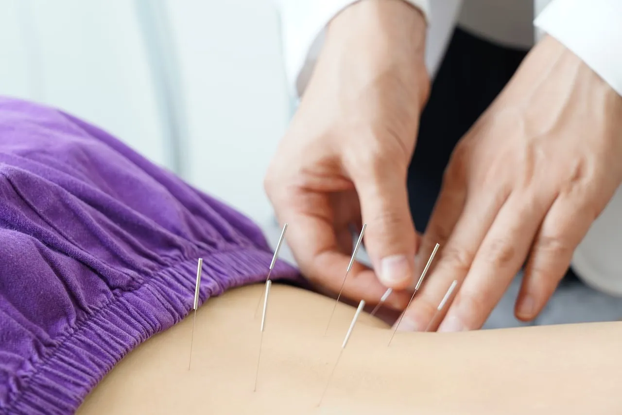 Fine acupuncture needles in the lower back (illustrative image)