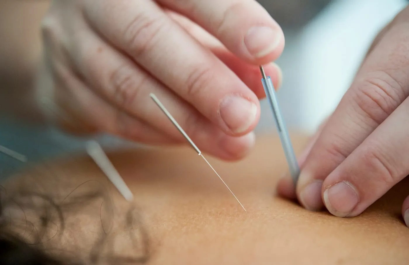 Close-up of fine needles being inserted into the skin
